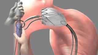 Thoracic Aortic Graft - Medical Animation by Watermark