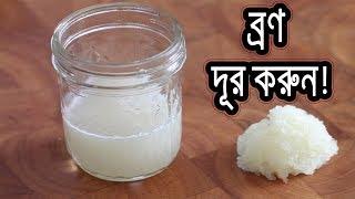 ব্রন দূর করবে রসুনের রস জেনে নিন কিভাবে ব্যাবহার করবেন || Benefits of Garlic