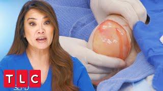 This Lipoma Is in “One of the Worst Possible Places” | Dr. Pimple Popper