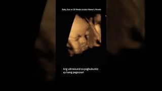 3D ultrasound  #pregnancy