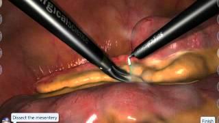 LapSim Appendectomy: Single Stapling