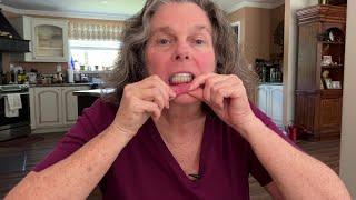 GOOD & BAD of my Dental Implants After 6 Months