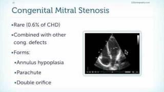 Mitral Stenosis Basics