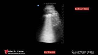 POCUS in COVID19