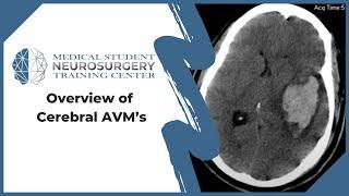 Overview of Cerebral AVM’s