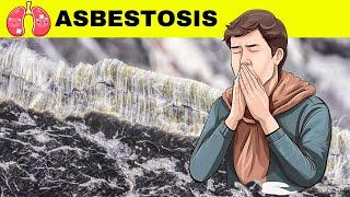 Asbestosis - Causes, Pathogenesis, Signs & Symptoms, Diagnosis, And Treatment