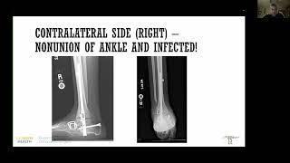 3D printed large defects for ankle salvage