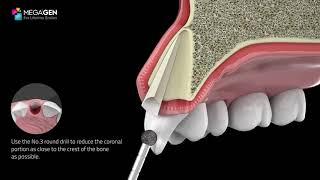 MegaGen PET Kit -  Socket Shield Procedure