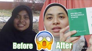 HONEST REVIEW SOME BY MI 30 DAYS MIRACLE SKINCARE KOREA