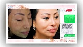 Trị Nám - Tàn Nhang Kiril |  Phản Hồi của khách hàng sau khi sử dụng
