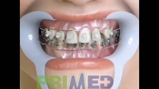 БРЕКЕТЫ. УСТАНОВКА БРЕКЕТ-СИСТЕМЫ.