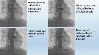 Fontan Fenestration Stent Migration: A Nightmare Retrieval