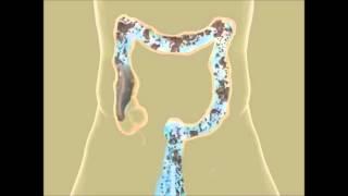 Colon Hydrotherapy in Pune | Constipation Treatment | Piles Treatment | Detox | Colon Cleansing IBS