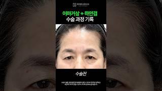 이마거상+하안검 수술 과정 기록