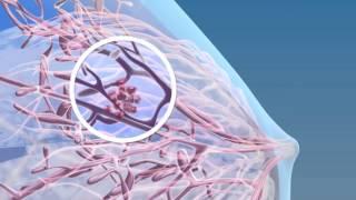 Breast Cancer - 3D Medical Animation || ABP ©