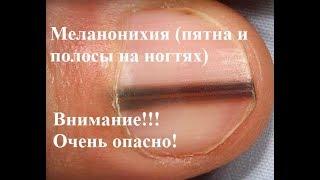 Меланонихия: пятна и полосы на ногтях. Очень опасно!!!