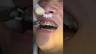 ÂM THANH MÀ NGƯỜI NIỀNG RĂNG MUỐN NGHE  #nhakhoathuyanh #dentist #funny