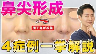 【鼻整形】団子鼻を卒業！タイプ別の治療方法を解説！【鼻尖形成】