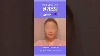 30대 초중반 여자 투턱 실리프팅의 기간별 효과