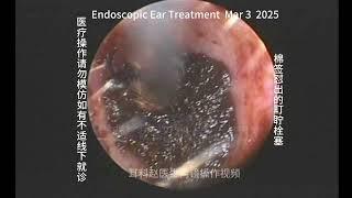 Natural formation of earwax embolism 20250303