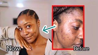 How i stopped my reoccurring acne and cleared up my skin | My skincare routine