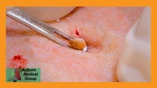 Dilated Pore of Winer Corn Feat. Dr. Gawayne | Auburn Medical Group