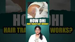 DHI Hair Transplant Explained #dhihairtransplant #hairtransplant #hair #shorts