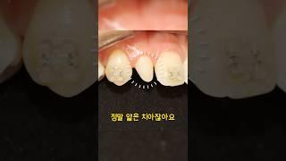 치과의사가 추천하는 왜소치 치료 방법! | 레진, 라미네이트