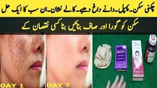 Skin Whitening Formula || No Pimple ||  No Acne By Sanam Ansari ||