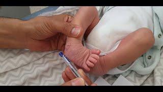 PIRANI SCORE : full explanation and evaluation  of a cublfoot in a 9 days old newborn