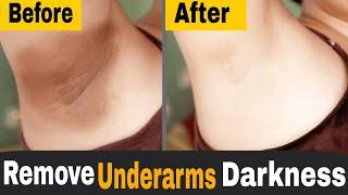 How To Lighten Dark Underarms at Home | Get Rid of Dark Armpits Naturally