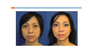 Upper and Lower Eyelid Lift, Blepharoplasty, Washingtonian Plastic Surgery Dr. Navin Singh