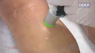 Motus-AX by DEKA - No.1 Pain-Free Laser Hair Removal