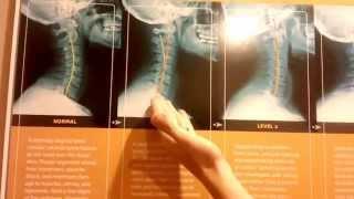 What TEXTING does to your NECK! - PART ONE - Pro Chiropractic Bozeman