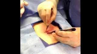 Umbilicoplasty and Hernia Repair