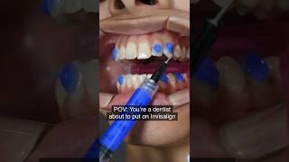 Invisalign attachments