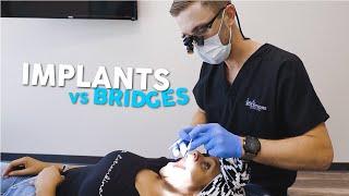 Dental Implants vs. Dental Bridge | Smile Solutions Dentistry | Harrisburg, NC