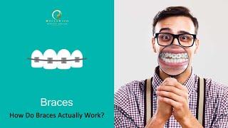 Metal Braces | How does it work ?