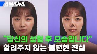 '성형 비포 애프터?' 성형정보 앱 회사에서 성형 부작용을 알리는 이유 / 스브스뉴스