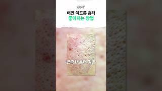 패인 피부도 매끈해질 수 있을까요? #여드름흉터#패인피부#프락셀