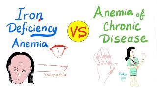 Iron Deficiency Anemia (IDA) VS Anemia of chronic disease (ACD)