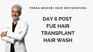 Day 6 Post FUE Hair Transplant Hair Wash