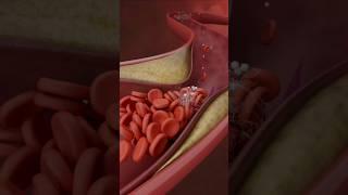 Lower Limb Angioplasty and Stenting|3D Medical Animation #LowerLimb#Stenting#Shorts #LowerLimb#viral