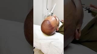 FUE Hair Transplant Turkey - 10th Month Update @cabhealth #hairtransplant #hairtransplantturkey