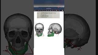 Oral Surgery question explaination | Fracture case | Mandible fracture MCQ ||