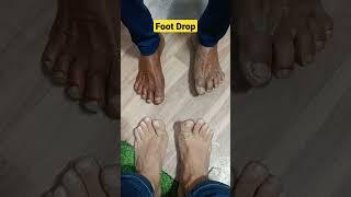 Foot Drop Case #shorts #physiodrdeepaksoni