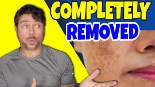 Amazing Age And Dark Skin Spot Removers  | Chris Gibson