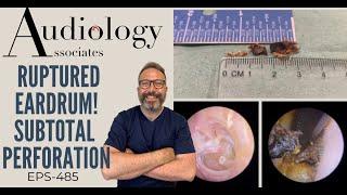 RUPTURED EARDRUM - SUBTOTAL PERFORATION - EP489