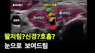 팔 신경증상 시술로도 낫지않는 이유?