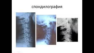 Vertebral diseases of nervous system s